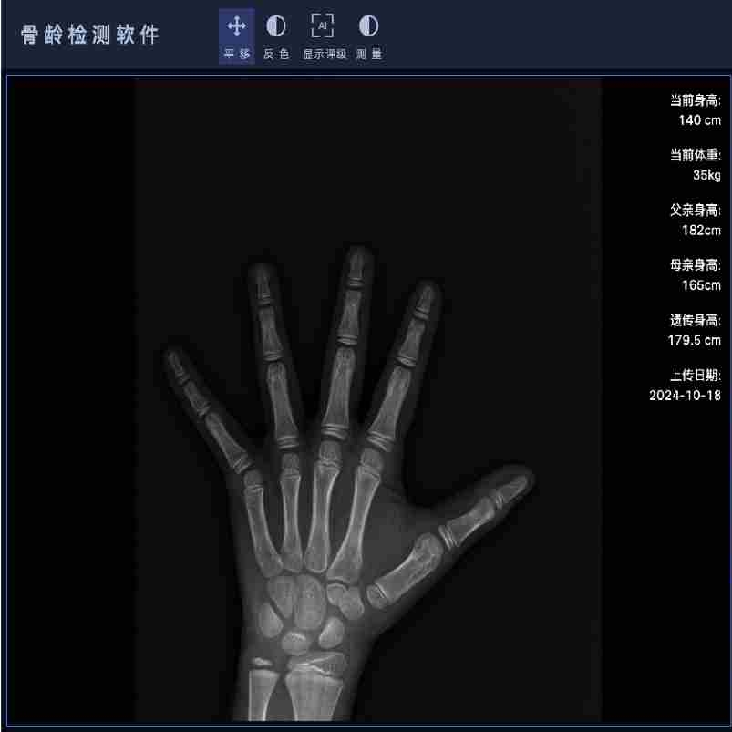 安智康 体育院校选材 一键生成报告 IDR-302HR-WF 骨龄检测设备