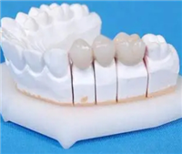 钴铬合金烤瓷桥定制式固定义齿厂家