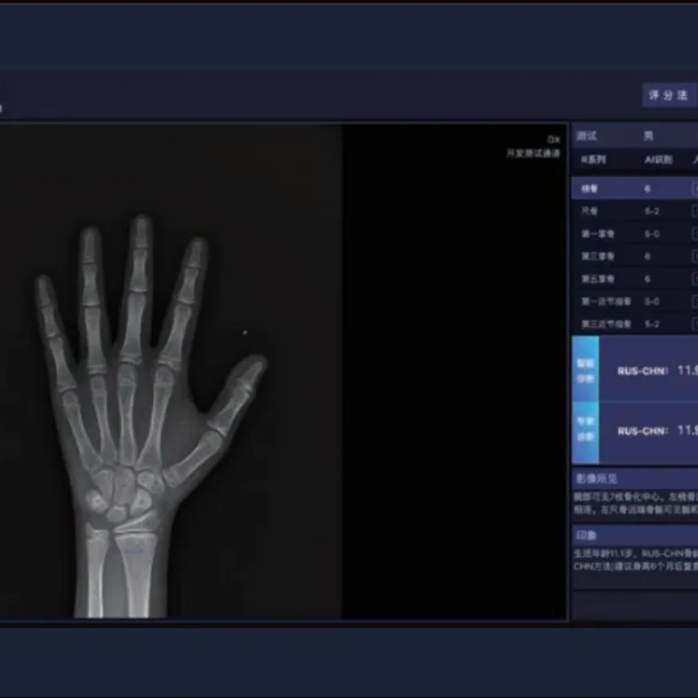 安智龄 误差仅0.28岁内 AI人工智能骨龄评测系统软件 AZK_Bone_Age