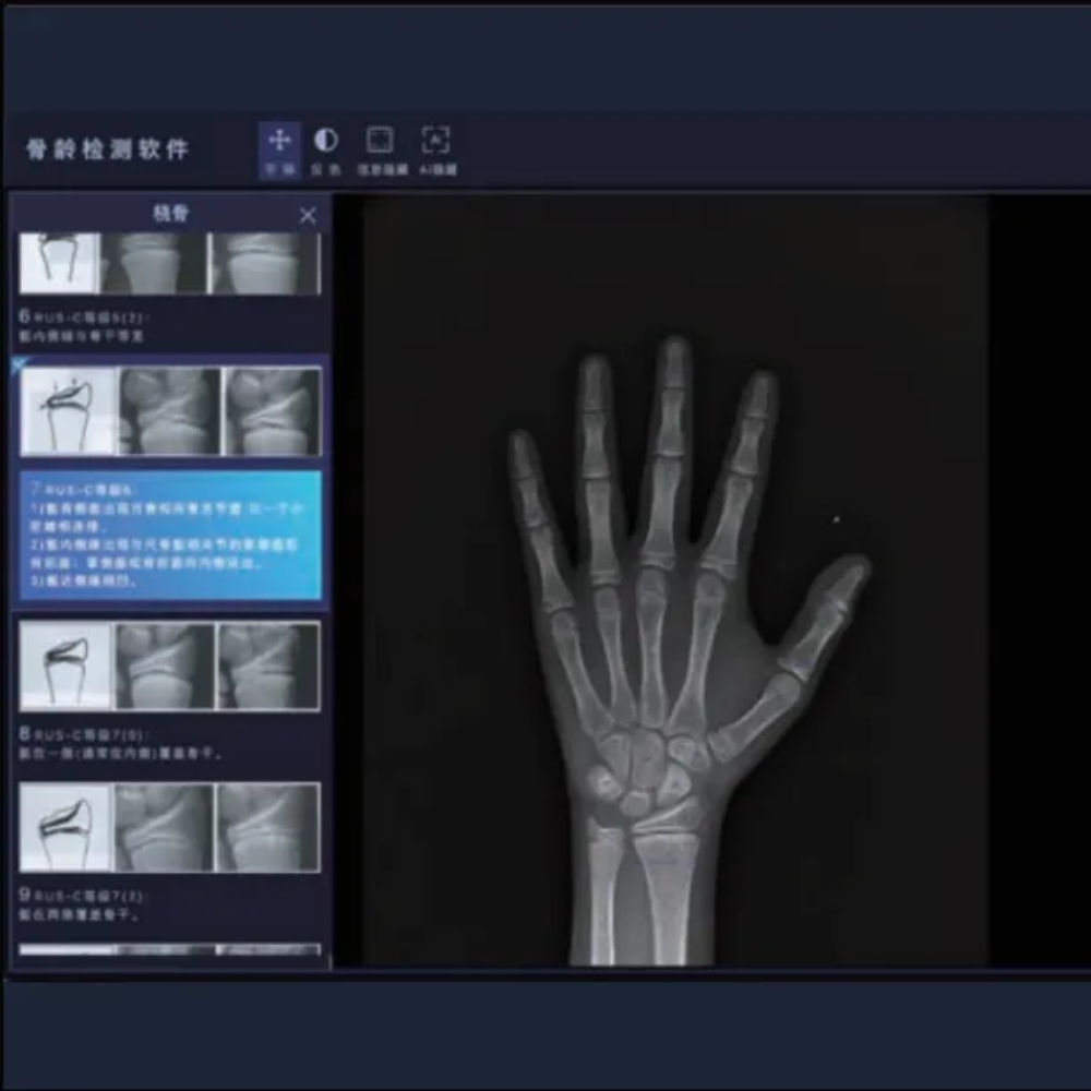 安智龄 误差仅0.28岁内 骨龄测定软件 AZK_Bone_Age