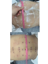 开封埋线减肥培训 一对一教学